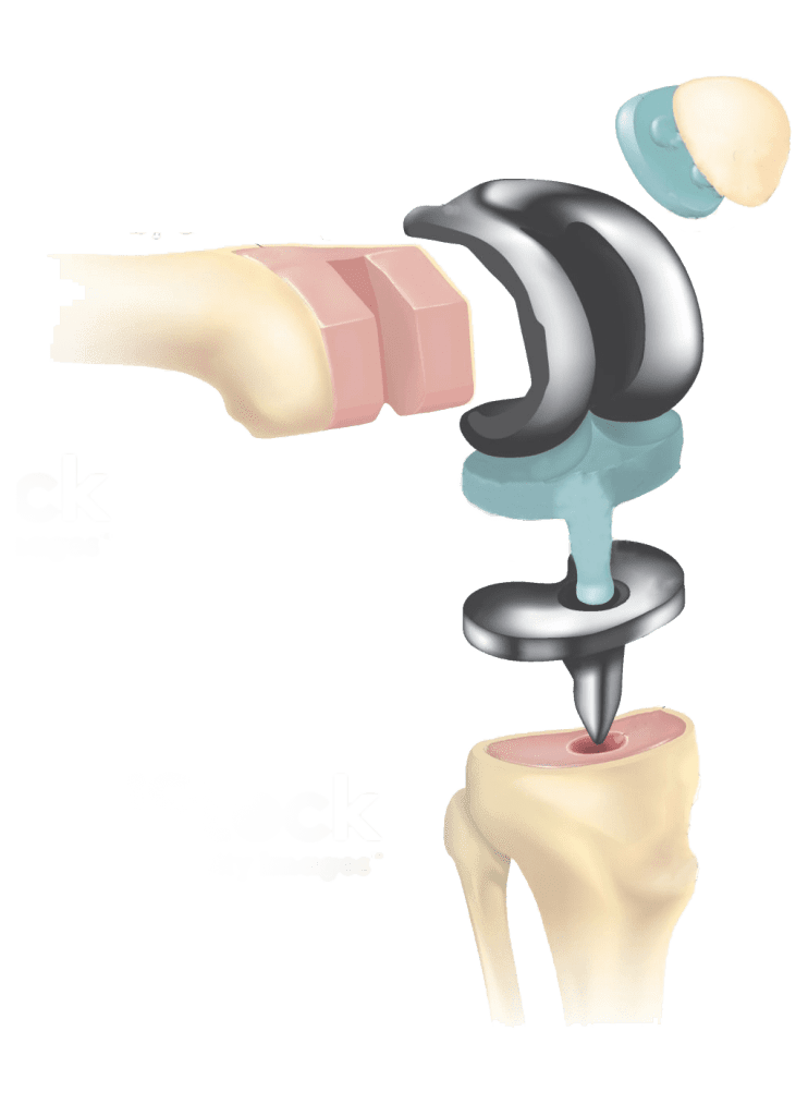 Knee Replacement Surgery Cost in India JaipurJoints