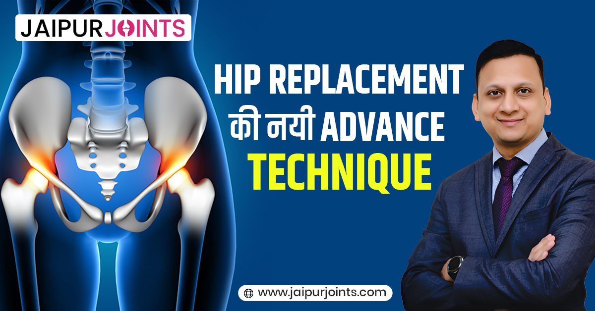 Hip Replacement की नयी Advance Technique