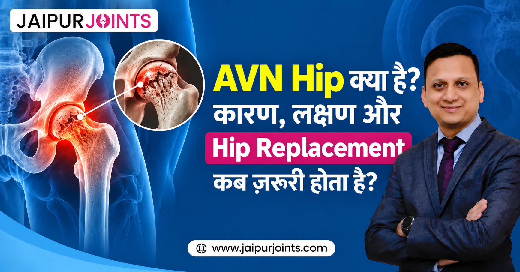 AVN Hip क्या है? कारण, लक्षण और Hip Replacement कब ज़रूरी होता है